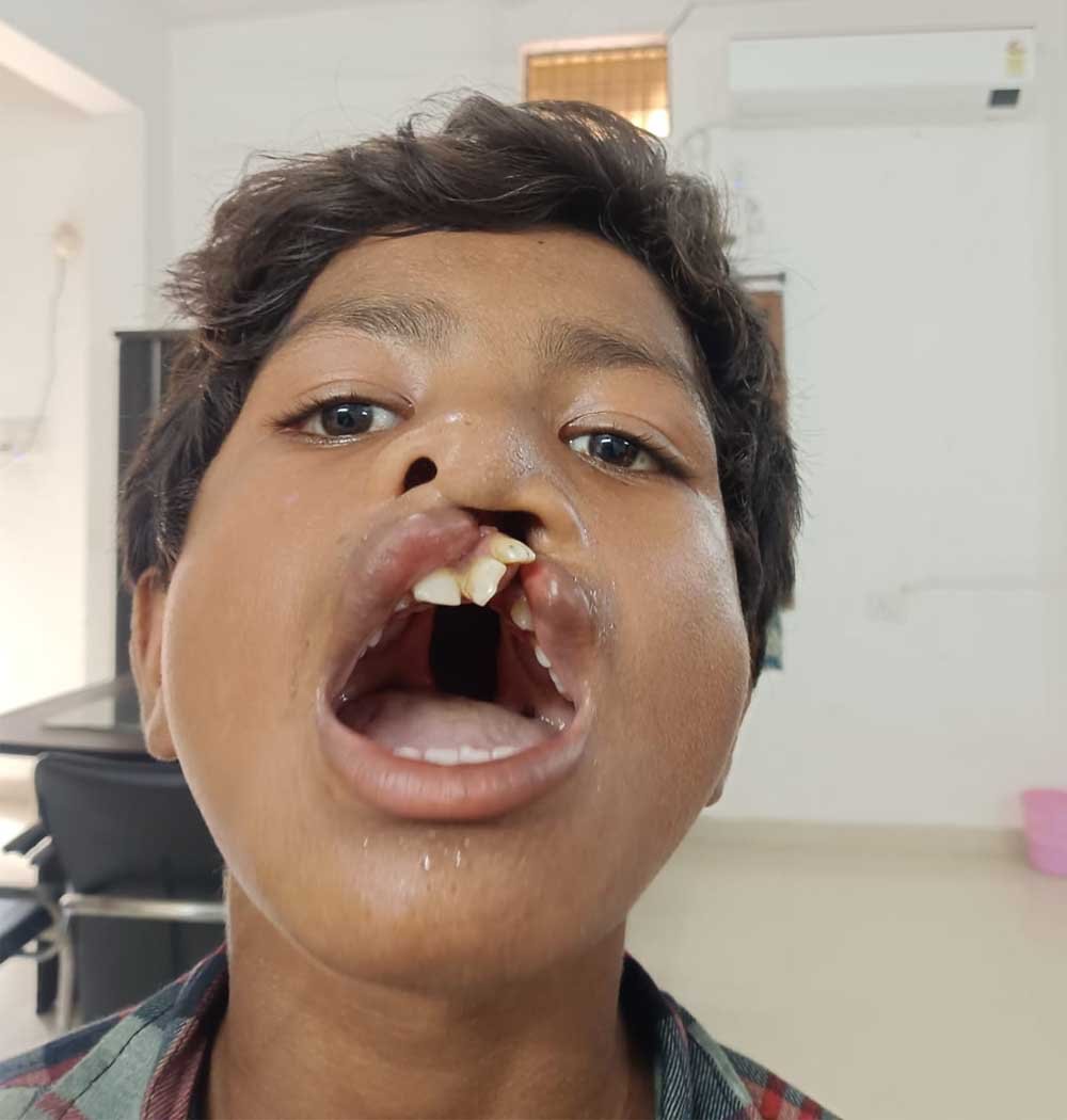‘चिरायु’ दल ने लौटाई मुस्कान, जन्मजात कटे होंठ और तालु से मिली मुक्ति ‘चिरायु’ दल ने लौटाई मुस्कान, जन्मजात कटे होंठ और तालु से मिली मुक्ति